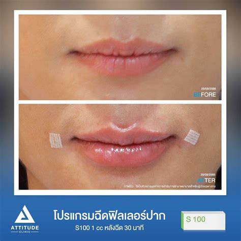 รีวิว Attitude Clinic ห้วยขวาง รีวิวโปรแกรมฉีดฟิลเลอร์ปากรุ่น S100