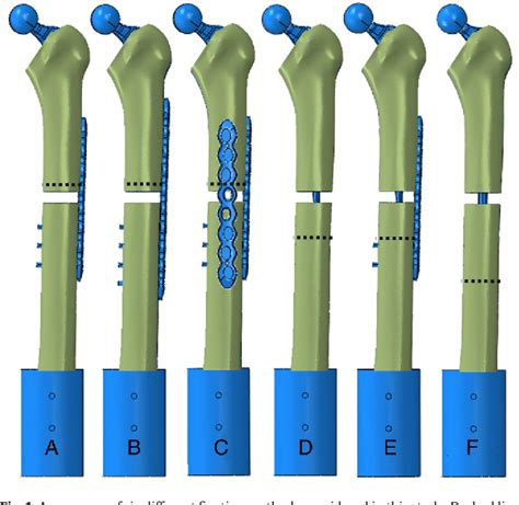 Figure 1 From Periprosthetic Femoral Fracture A Biomechanical