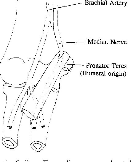 Figure 1 From Median Nerve Compression Within The Humeral Head Of Pronator Teres Semantic Scholar