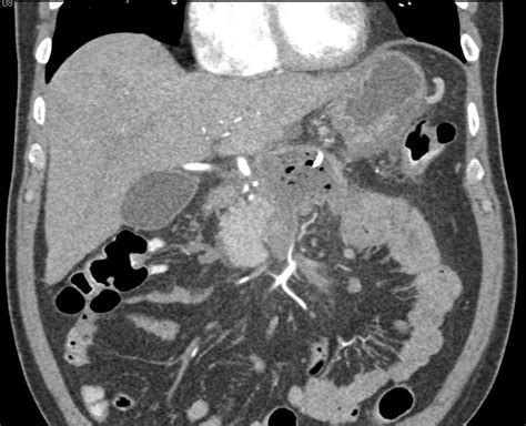 Renal Abscess Ultrasound