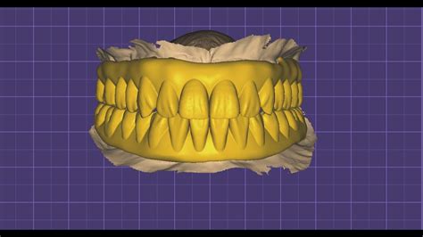 Full Mouth Designing With Preop Scan In Exocad Elefsina For Durable