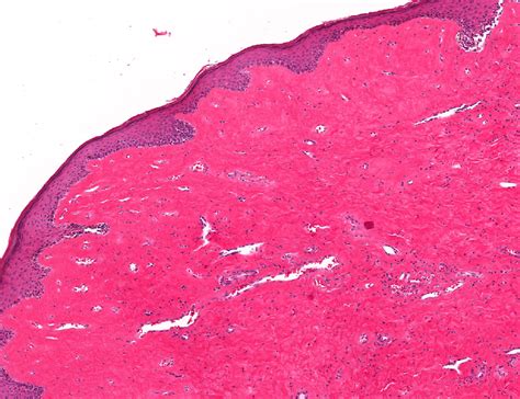 Pathology Outlines Lichen Sclerosus Balanitis Xerotica Obliterans