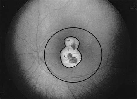 Area Of Macular Scar From Treated Retinoblastoma Scar Outlined Within Download Scientific