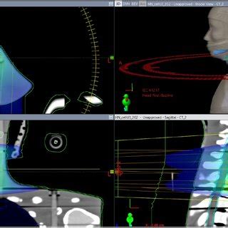 Dose Distribution On Axial Sagittal And Coronal Views And A 3D View