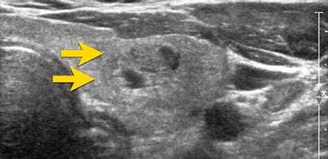 The Radiology Assistant Ti Rads Thyroid Imaging Reporting And Data