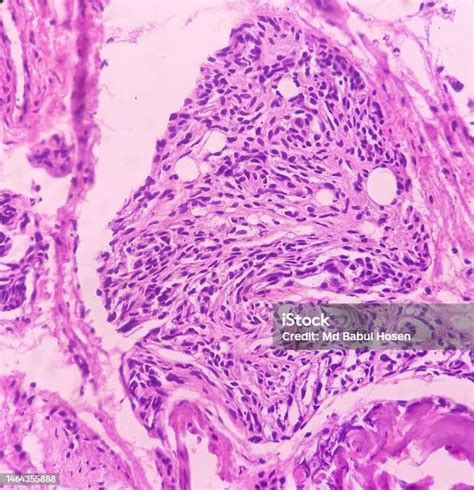 Foto De Biópsia Palpebral Hemangioma Capilar Lobular Esfregaço Mostra