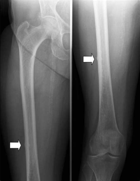 Femur x-ray anatomy Diagram | Quizlet