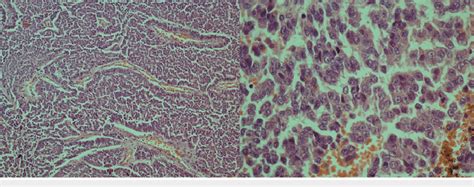 Adult Granulosa Cell Tumor Shows Diffuse And Trabecular Growth The