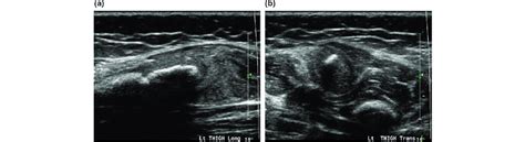 Longitudinal A And Transverse B Ultrasound Images Of The Vastus