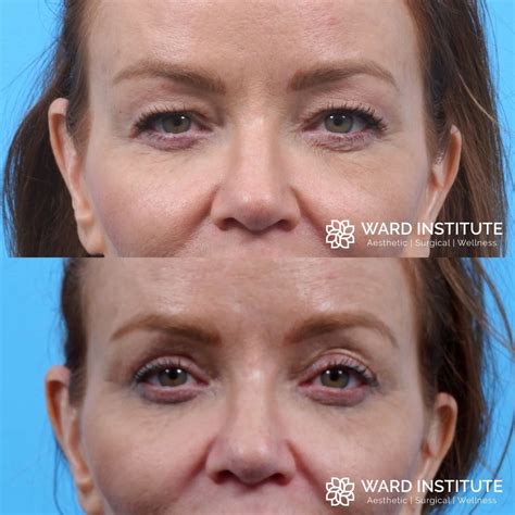 Blepharoplasty Plastic Surgery In Slc Ut Ward Institute