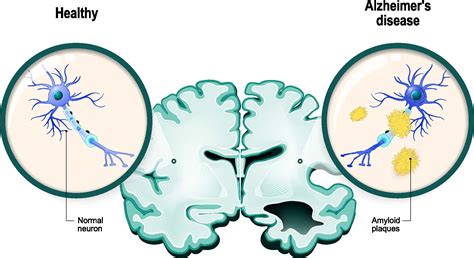 Biogen S Antibody For Alzheimer S Disease