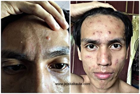 Pantang Larang Chicken Pox Dewasa Simptom Chicken Pox Pada Orang