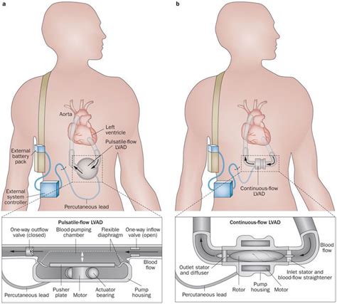 Pin on LVAD