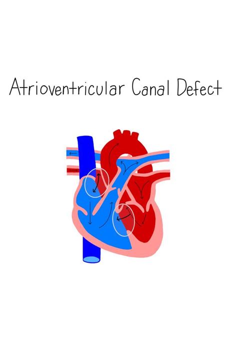 Understanding Atrioventricular Canal Defect