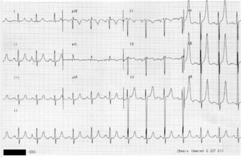 EKG triggers and pictures Flashcards | Quizlet