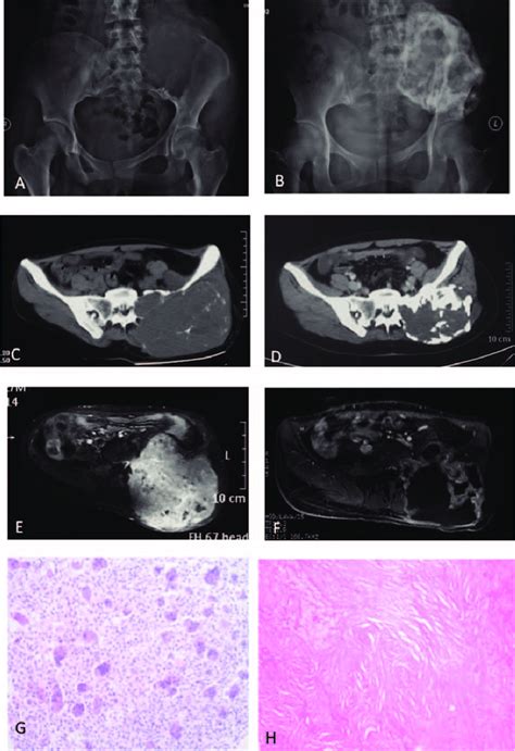 A H A 22 Year Old Female With Left Pelvic Large Gct A Plain Download Scientific Diagram