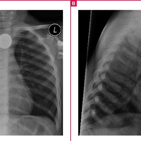 Red Herrings A The Postero Anterior And B Lateral Plain Chest