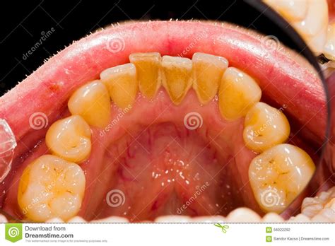 Plaque Removal Treatment stock photo. Image of close - 56022292