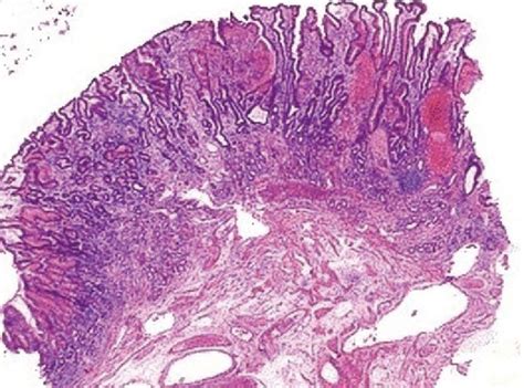 Gastric Antral Vascular Ectasia | Semantic Scholar