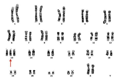 Trisomy 13(Patau Syndrome)- Definition, Causes, Symptoms, Life ...