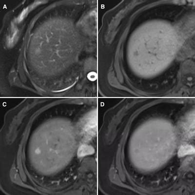 Frontiers Case Report Hepatic Epithelioid Angiomyolipoma With