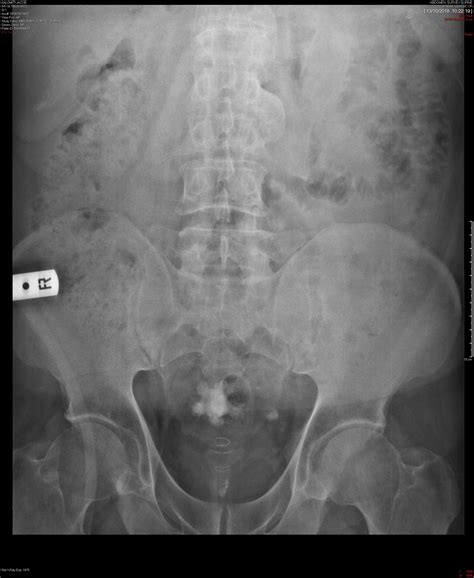 Kub Xray Labeled at Hayden Atkin blog
