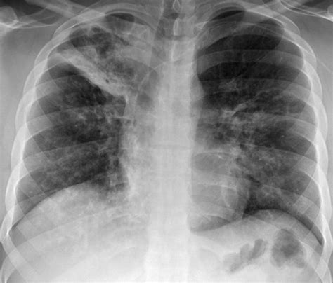 Blastomycosis Lung X Ray