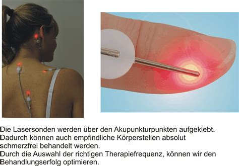 Laser Akupunktur Teuber Bogenrieder Tcm Akupunktur Metabolic