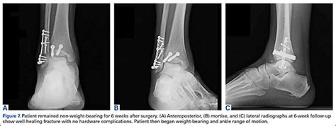 How To Fix Posterior Malleolus Fracture | Sitelip.org