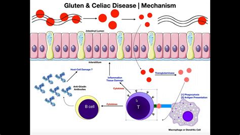 GLUTEN Mechanisms Of Celiac Disease And Gluten Sensitivity YouTube