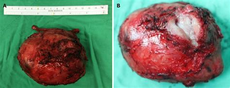 Figure 1 From Robotic Surgery In Giant Multilocular Cystadenoma Of The Prostate A Rare Case