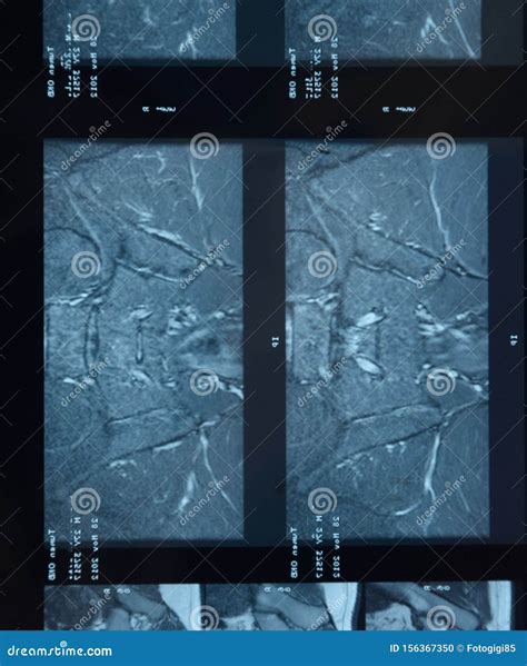 MRI Sacroiliac Articulation. Study of Ankylosing Spondyloarthritis