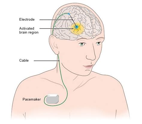 Parkinsons Disease Deep Brain Stimulation Informedhealth Org