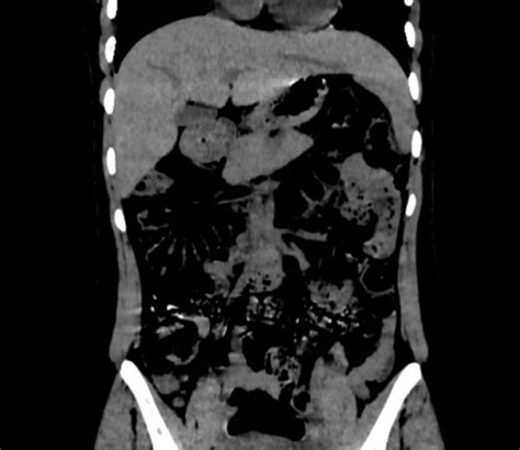 Brown Hospital Medicine On Twitter A 30 Year Old Woman Presented With