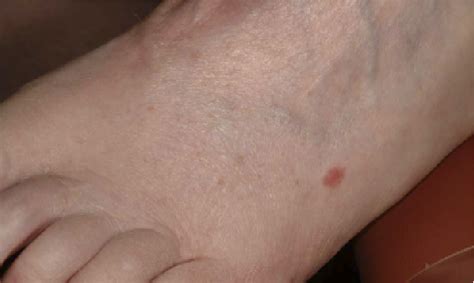 Amelanotic Nodular Melanoma