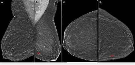 3d Screening Mammogram Findings A Mediolateral Oblique View And C