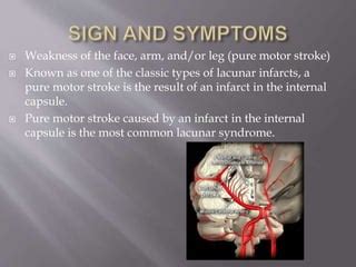 Applied aspect of internal capsule | PPT