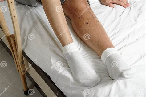 Female Patient With Postoperative Suture After Surgery On Broken Leg