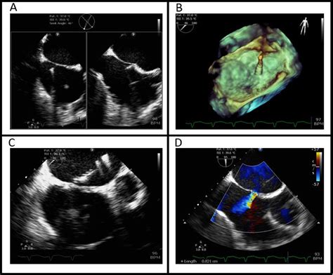 Limited Balloon Atrial Septostomy For Left Ventricular Unloading In