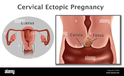 Illustration Of A Cervical Pregnancy This Is A Type Of Ectopic Pregnancy Where The Fetus Grows