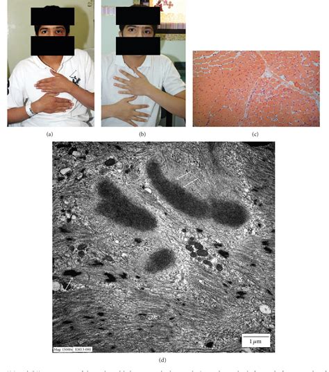 Figure 1 From Unilateral Heliotrope Rash In Juvenile Dermatomyositis