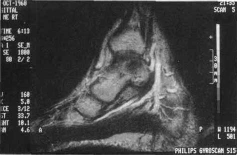 Tarsal Tunnel Syndrome Mri