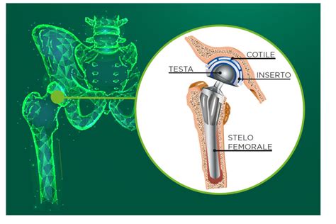 Protesi Anca Quando Necessaria Quali Gli Interventi A Disposizione