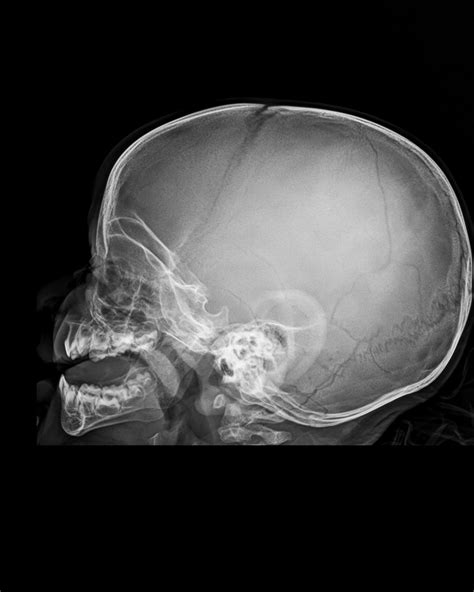 Basilar Skull Fracture Child at Jerome Leonard blog