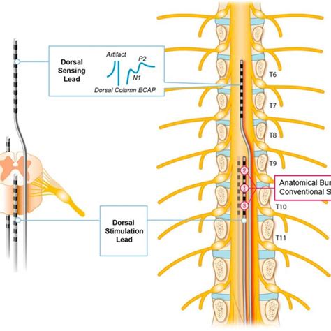 Conventional And Burst Spinal Cord Stimulation Download Scientific Diagram