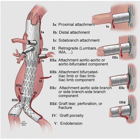 Fig Novel Proposed Classification Of Target Vessel Endoleaks Ima