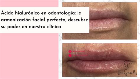 Ácido Hialurónico en Odontología La armonización facial perfecta