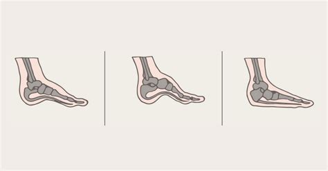 What is Overpronation? Causes and Treatments - Heel That Pain