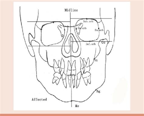 The Described Measurement Points Of Cephalometric Radiographs