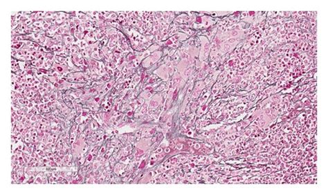 Reticulin Stain Of Bone Marrow Showing 2 Fibrosis Download